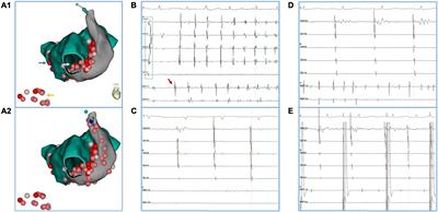 Catheter ablation for atrial fibrillation in patients with persistent left superior vena cava: Case series and systematic review